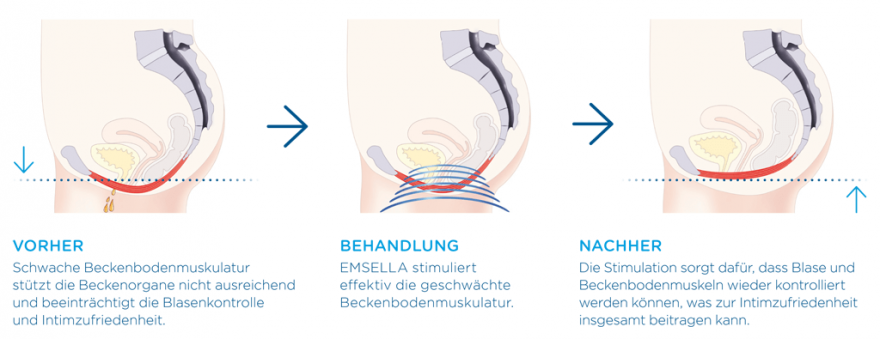 BTL Emsella®: Nicht-invasive Lösung bei Inkontinenz - Frauenarzt Augsburg Dr. Fischer & Kirschbaum